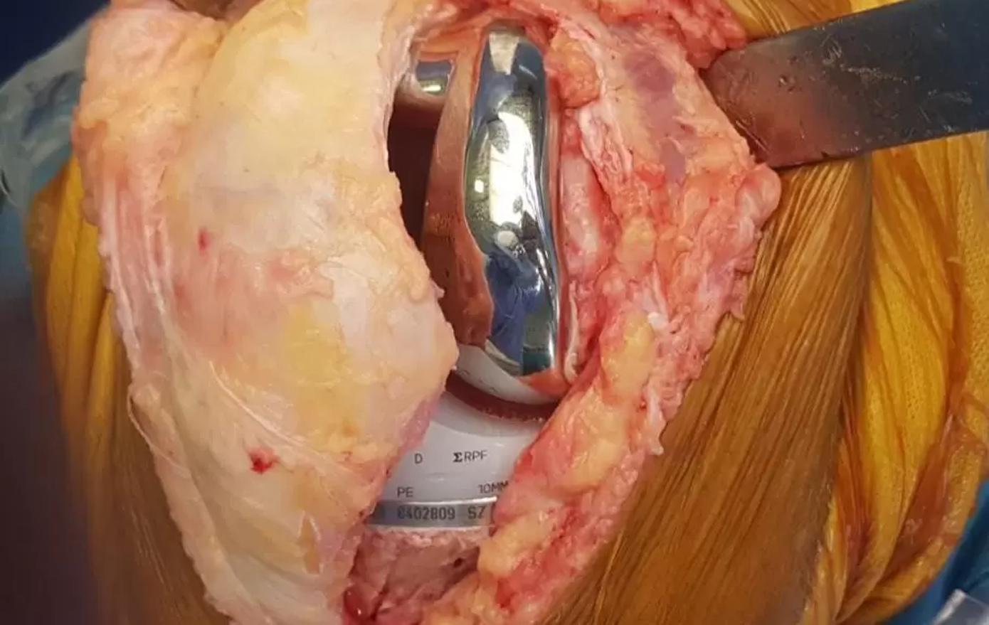 Minimally Invasive Knee Replacement in Andheri